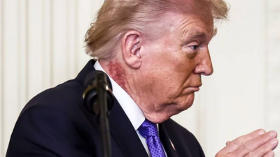 What's Behind Trump's Neck Rash? Bruised Hands and Swollen Ankles Spark Mounting Health Alarm As Shingles Fears Grow