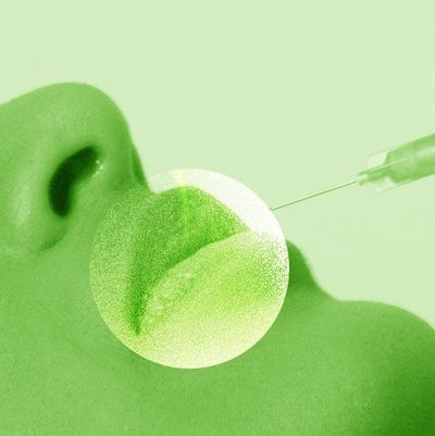 I Was Getting Lip Filler for Years—This Week, I Dissolved All of It