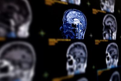 Researchers say AI can predict Alzheimer’s disease with close to 93 percent accuracy