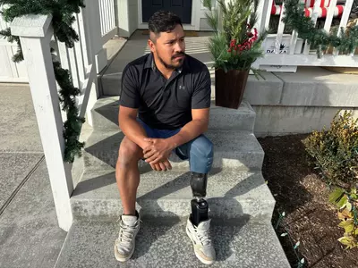 Workplace Amputations Are on the Rise in Texas and Nationwide