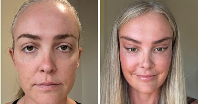 “Someone PAID For This”: People Go Wild Mocking Woman’s Before-And-After Cosmetic Procedure