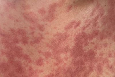 Meningitis B: The symptoms to know as fourth case confirmed in Reading