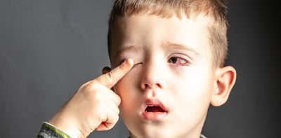 Why arthritis in children can threaten eyesight