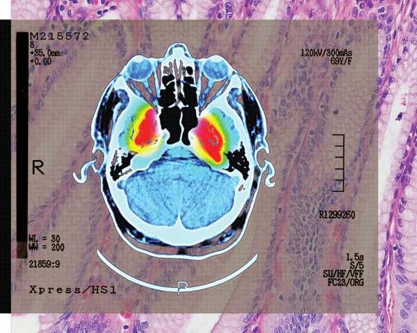 ‘Strong evidence’ of lowered dementia risk: the benefits of shingles vaccination