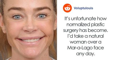 Denise Richards Reveal Before-And-After Look Following Wild Surgery