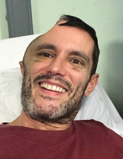 'I fell down the stairs at Oxford Circus station and woke up in hospital with half my head missing'