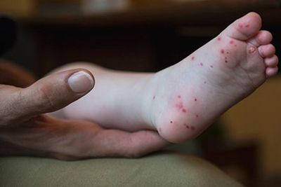 Hand, foot and mouth disease symptoms after three die in Vietnam