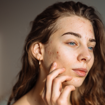 The Definitive Guide to Treating Every Type of Scar