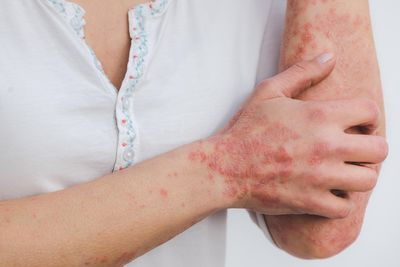 Psoriasis Skin Management for Plaque Psoriasis with Biologic Injections and Skin Barrier Repair