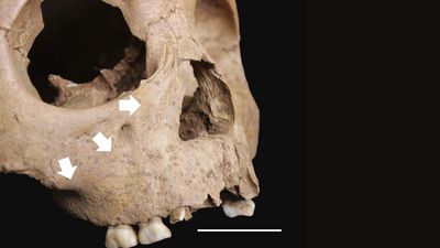 Ancient children's teeth reveal a syphilis-like disease was spreading in Vietnam 4,000 years ago