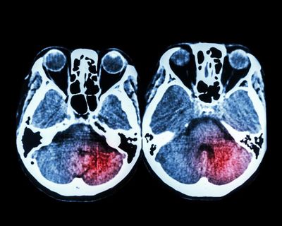 Key stroke treatment still not available around the clock across England