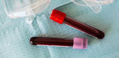 Treating previously untreatable cancers: How CAR-T cell therapy could be made accessible to more patients