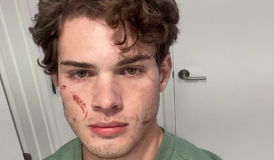 Clavicular Revelation: Looksmaxxing Influencer Claims 'Face Descending' from Life Support Mask Was Worse Than Overdose