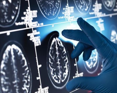 Effect of ‘gamechanger’ Alzheimer’s drugs ‘trivial’, review concludes