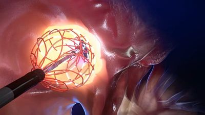 Deep inside the heart: the innovative catheter designed to revolutionise the treatment of arrhythmia