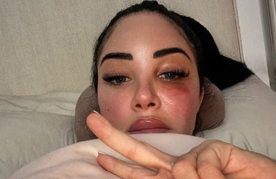 Tulisa Contostavlos suffering 'minor paralysis' after Bell’s palsy attack