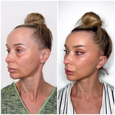 Transforming Faces, Affirming Identity: Inside the World of Facial Feminization Surgery with Dr. Harrison Lee