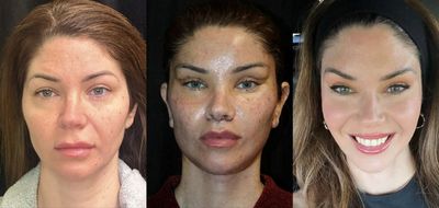 Fixing Failed Eye and Eyelid Surgery: One of the Hardest Procedures in Cosmetic Medicine with Dr. Sumeet Jindal