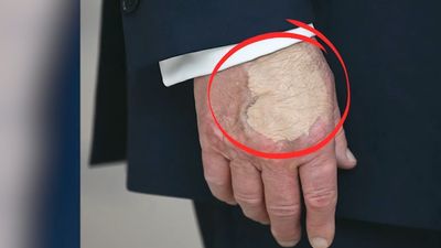 Did Trump Use Makeup During the Press Dinner? Reports Claim Thick Coating of Mismatched Concealer Spotted on POTUS' Right Hand