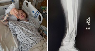 “I heard it snap over the screaming crowd! Sounded like a damn 2x4”: Billy Strings forced to reschedule tour after breaking leg in skating accident