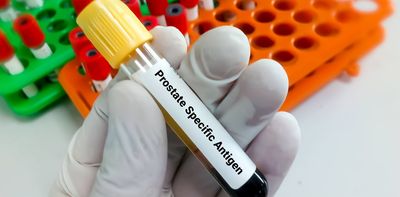 Prostate cancer overdiagnosis risk sharply rises after age 70 – new research