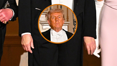 Donald Trump disease hands drama thickens, both hands now affected, official excuse increasingly flimsy