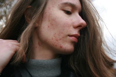 Best Ways to Get Rid of Acne and Prevent Breakouts Naturally: Clear Skin Tips That Work