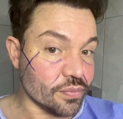 Bobby Norris Before and After Photos Emerge After Star Reveals 'New Face' on This Morning