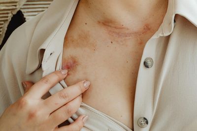 Best Ways to Remove Wound and Acne Scars: Effective Treatments for Clearer Skin