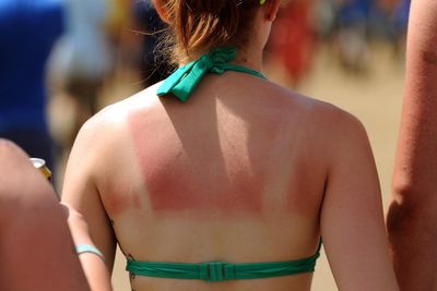 Skin cancer warning as one in nine Britons admit to deliberately burning themselves to tan