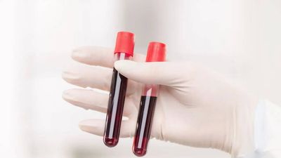 World’s rarest hybrid blood type discovered in Thailand: Study found in just 3 people out of a massive research of 544,000 samples
