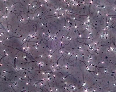 Man produces sperm from testicular tissue frozen as a child in breakthrough trial