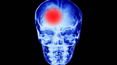 Both very low and very high heart rates may be linked to higher stroke risk, study says