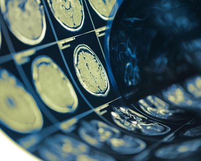 Lacunar strokes caused by widening of arteries in brain, study suggests