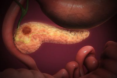 Promising drug found to double survival rate for advanced pancreatic cancer patients