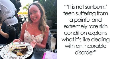 Teen With An Extremely Rare Skin Condition Talks About Her Struggles Online, Ends Up Going Viral