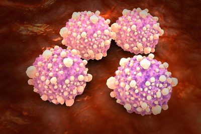 The new drug offering hope for pancreatic cancer patients