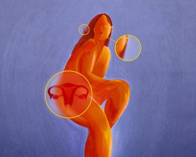 What is PCOS, what are the symptoms and treatment, and why is it being renamed PMOS?