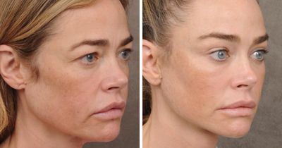 15 Times Celebrities And Influencers Shared Their Plastic Surgery Results Openly
