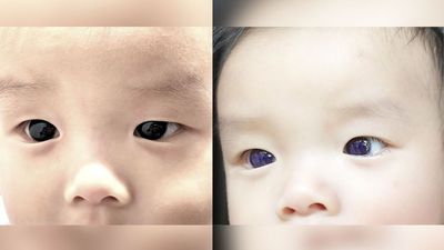 Diagnostic dilemma: An infant's brown eyes turned indigo after COVID antiviral treatment