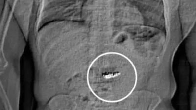 Florida pooper swipes nearly $800k in diamonds. Then cops check his stomach: ‘should have thrown them out the window’