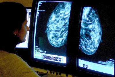 When should you get a mammogram? The latest information amid conflicting advice
