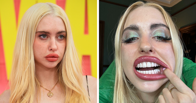 Chloe Cherry Sparks Frenzy After Revealing Disturbing Effect Of Repeated Lip Filler Procedures