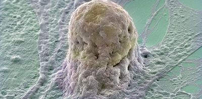 Stem cells have potent potential for diabetes treatment