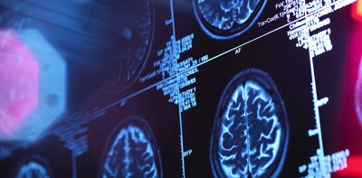 Blood biomarkers could detect earliest signs of Alzheimer’s disease – and slow its progression