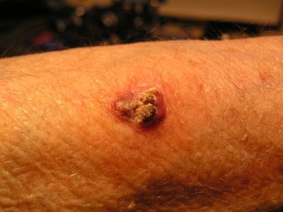 Deadliest Skin Cancer Cases Hit Record High in the UK as Experts Blame Sun Exposure and Sunbed Use