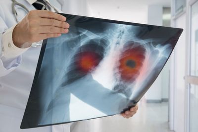Supermarket lung cancer checks find 10,000 cases in England
