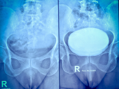 Covid is now hitting young Indians in a shocking new way, doctors say people in their 30s are suddenly needing hip replacements