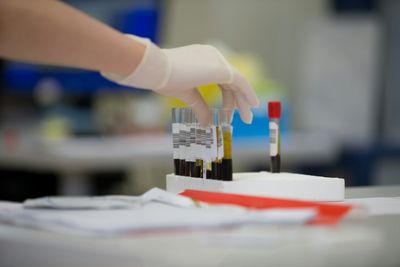 Simple Blood Test May Help Detect Colorectal Cancer Earlier, Researchers Say