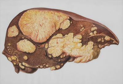 Experimental Drug Shows Promise in Stopping Progression of Severe Fatty Liver Disease